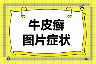 中医是怎样治疗牛皮癣的